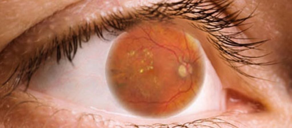 Retinopatia Diab Tica Exige Cuidado Especial Inspire Sa De